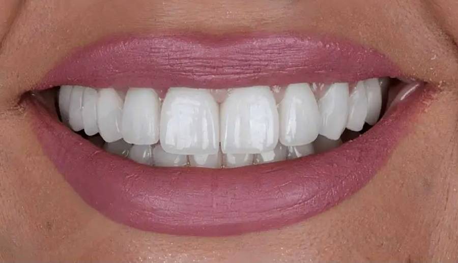 Smile after treatment