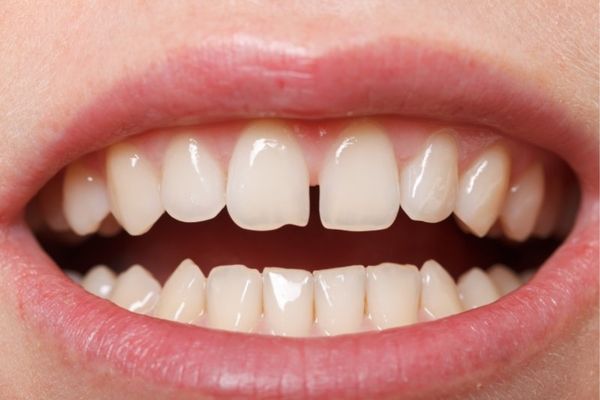 Diastema (gapped teeth)